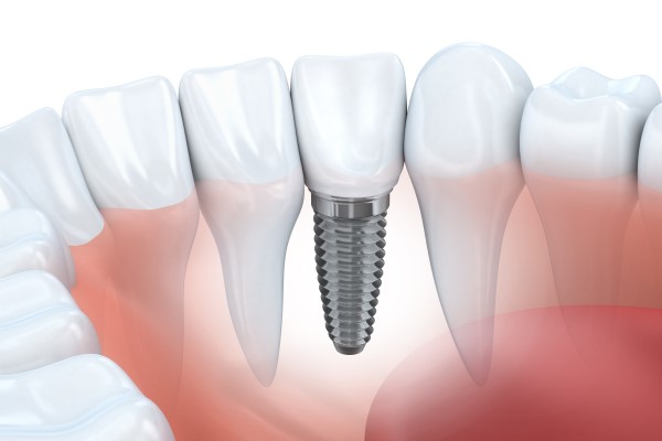 Dental Implant Restoration Normal, IL