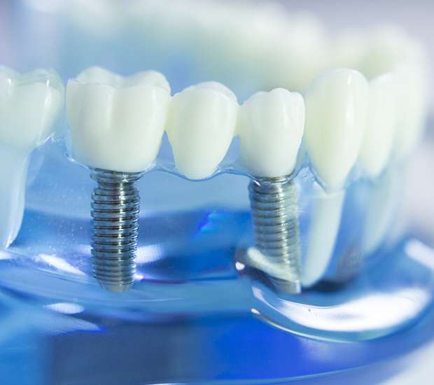 Normal Dental Implants